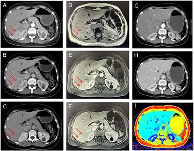 Retroperitoneal Castlemans disease mimicking a liver cancer: a case report